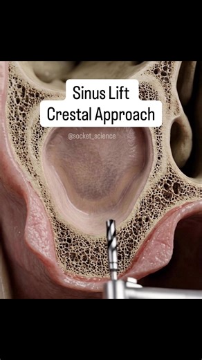 The Engineering of Space: Crestal Sinus Lift 🦷🔬 When the maxillary bone lacks the vertical height for a stable implant, we don't just stop—we engineer the foundation. This macro-visualization shows the