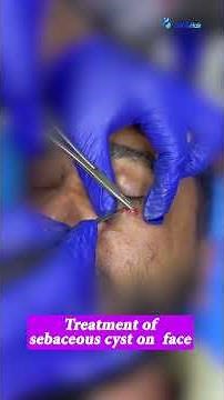 Treatment of sebaceous cyst on face | By Dr. Uttam Kumar Lenka MBBS, MD (Consultant Dermatologist)