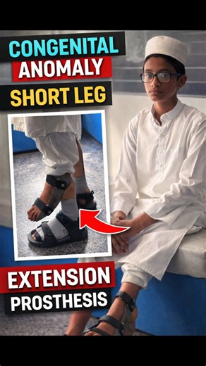 Extension Prosthesis | Short Leg Solution | Congenital anomaly | Custom Orthoses #congenital #best
