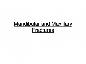 Mandibular and Maxillary Fractures - SlideServe