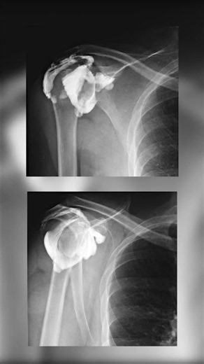 Rotator Cuff Tear Arthrogram Case #shorts