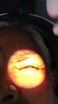 Speculum free simple technique of INTRAVITREAL INJECTION By Dr. Ajay dudani