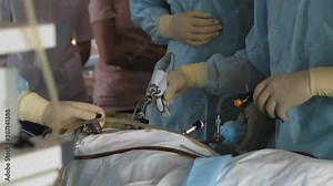 Laparoscopic surgery with use of modern medical equipment in operating room. Surgical intervention in abdominal cavity for treatment or elimination of pathology, careful precise movements of doctor Stock Video