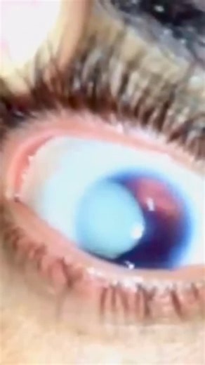 Eye Conditions Explained on Instagram: "Aniridia with Lens Dislocation 👁️ Aniridia is a rare congenital eye condition characterized by the partial or complete absence of the iris, the colored part of the eye that controls light entry. Beyond the visible iris abnormality, aniridia is a complex disorder that may involve multiple ocular structures, including the cornea, lens, retina, and optic nerve. Patients often experience reduced visual acuity, significant photophobia, nystagmus, and an increa