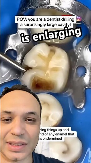 Dentist Drilling a Cavity 😳🦷 #youtubeshorts #dentist #dental