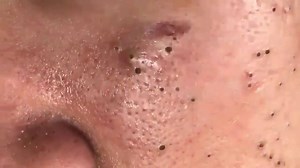 7.9K views · 29 reactions | Blackhead REMOVAL #19  WATCH OTHER...