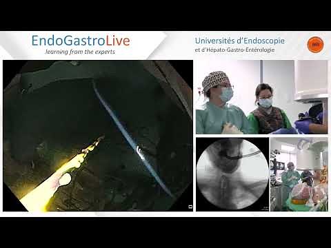 Mise en place d'une gastrostomie push