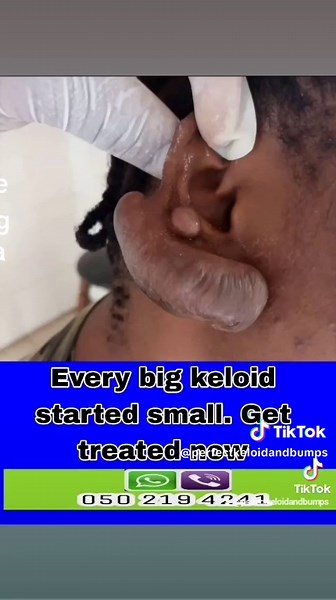 Every big keloid started small. #keloid #keloidtreatment #ghana #skincare #keloidremoval