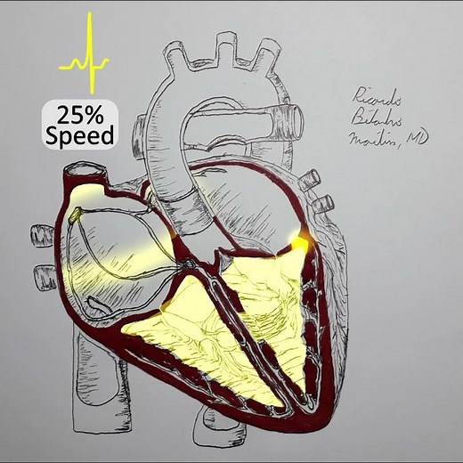 AVRT / Wolff Parkinson White explained in 1 minute