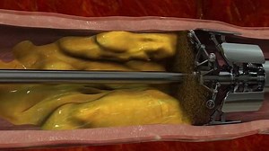 This amazing device could 'eat' bad cholesterol in your arteries. | Insider Tech