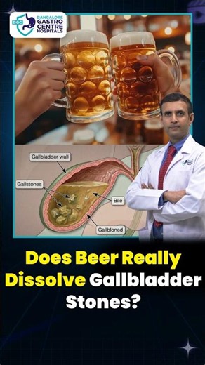 Can Beer Remove Gallbladder Stones Naturally? Doctors Explain the Truth!