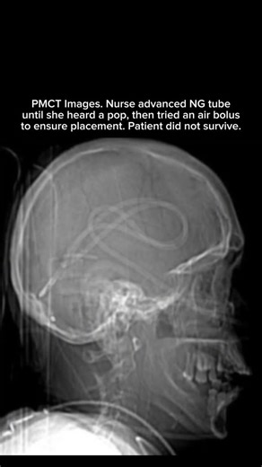 VIEWS on Instagram: "In a rare but catastrophic complication published in Interdisciplinary Neurosurgery, a 47‑year‑old woman who had undergone transsphenoidal surgery for a pituitary tumour suffered inadvertent intracranial placement of a nasogastric tube during postoperative enteral feeding; the tube passed through the skull base into the ventricular system, intracranial hemorrhage developed, and despite removal of the tube and subsequent neurosurgical care, the patient died eight days later. 