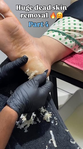 25K views · 1.2K reactions | WhatsApp 03032002320 Unbelievable Huge Dead Skin Removal ✨ #deadskinremoval #hugedeadskin #footcleaning #pedicurecare #satisfyingvideo #foottransformation #skincarevideo #relaxingpedicure #asmrfeet #deepcleaning #footcare #dermacare #callusremoval #feetcare #viralreels #reelsviral #reelitfeelit #fypシ #trendingnow | Faraz Khan | Facebook
