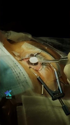 Opérate la visión borrosa 👁️⚡ miopía, astigmatismo e hipermetropía