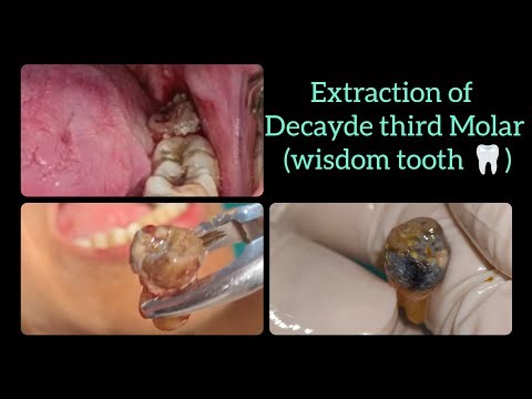 Watch How Easily & Painless Extraction of Decayde wisdom tooth 🦷