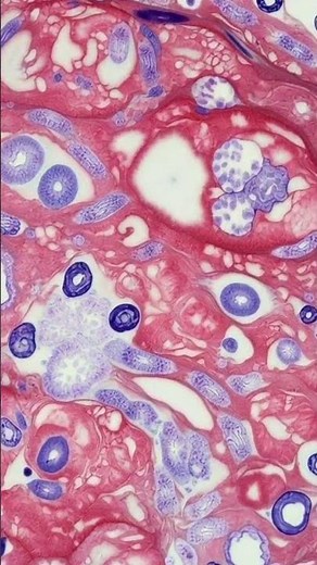 Historical View of Breast Cancer | The human blueprint