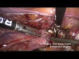 Hysterectomy for Beginners - Tips and Tricks • Video • MEDtube.net