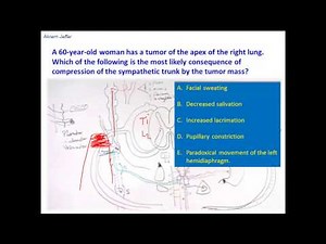 Consequences Of Compressing Thoracic Sympathetic Trunk • Video • MEDtube.net