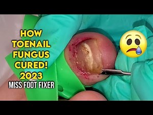 HOW TOENAIL FUNGUS CURED BY REMOVING FUNGAL NAIL FULL PROCEDURE BY FAMOUS PODIATRIST MISS FOOT FIXER