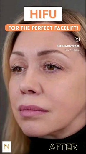 HIFU Treatment Before & After #hifutreatment #hifufacial #hifufacelifting #facelift