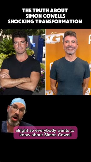 Dr. Matthew J Nykiel on Instagram: "Simon Cowell admits to Botox and fillers, but as plastic surgeons, we’re seeing evidence of actual surgical procedures. Let’s break it down: 1. Scleral Show (Lower Eyelid Issue) 👁️ Before: No visible white (scleral show) around the iris of his eye After: Clear scleral show, where the white of the eye is visible below the iris While some scleral show can happen naturally with age as fat pads are lost, the degree we’re seeing suggests a complication from lower