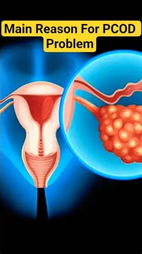 Main Reason For PCOD/PCOS Problem || How Can Treat #doctor #healthylife #periods #ytshorts