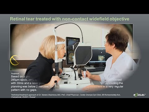 Laser retinopexy: Non-contact navigated laser treatment of a retinal tear with Navilas® 577s