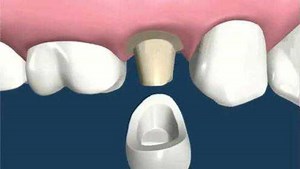 全瓷牙冠修复的过程，动画解析这一切！