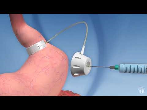 Laparoscopic adjustable gastric banding