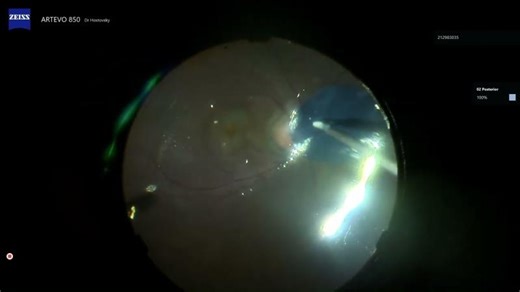 opticpitamniioticmembrane | Avner Hostovsky