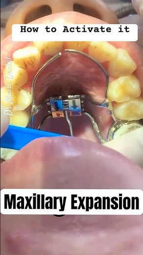 Activation of Maxillary Expansion, Orthodontics Devices