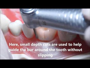 PFM Crown Preparation