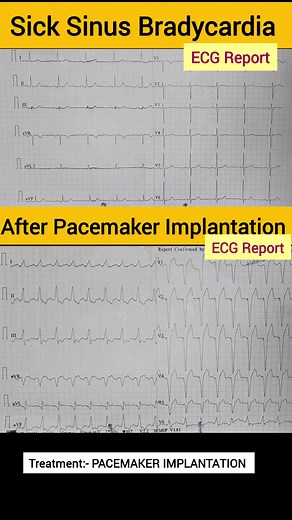 Sick Sinus syndrome ECG then Pacemaker ECG #ECG #ekg #pacemaker #surgery #disease #treatment #health #heartcare #healthtips #heart #heartattack #heartbeat #hearttreatment #HeartHealth #cardio #cardioworkout #cardiovascular #reelsvideoシ #viralreels #fbreelsvideo #reelsfb #facebookreels #explorepage #healthcare #reelsvideo #reel #instagram #instagood #explore | Sonu Sharma