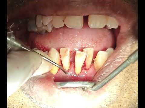 “From Bleeding to Healing | Scaling + Root Planing Demo” #bleeding #bleedinggums #tartar#gumcleaning