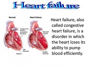 Heart failure - SlideServe