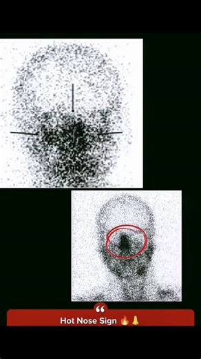 RK NURSE'S HUB on Instagram: "The "hot nose" sign is a radiologic finding observed during nuclear medicine brain scans that can support a clinical diagnosis of brain death. Key Characteristics Definition: It is the appearance of intense radiotracer activity (a "blush") in the nasal and nasopharyngeal regions on a cerebral perfusion scan. Mechanism: When brain death occurs, intracranial pressure typically exceeds cerebral perfusion pressure, causing blood flow to cease in the internal carotid art