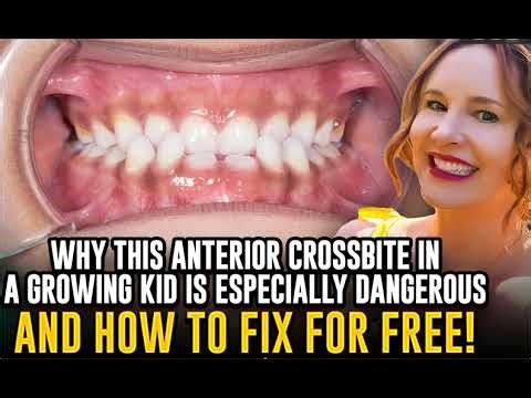 How to Fix an Anterior Crossbite in Early Mixed Dentition for Free