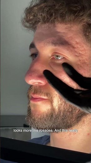 Treating Boxcar & Rolling Scars with TCA Cross & Subcision