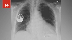 25 accidental inventions that changed the world