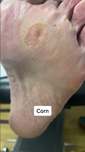 Join us on a journey of relief! Watch this corn & callus removal by our expert podiatrist.