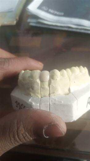 metal fused to porcelain cap quality check..