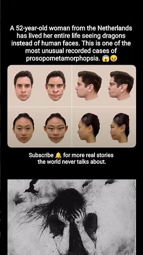 52 Years Seeing Dragons: A Mind That Never Saw a Human Face 🧠🐲 #shorts #medical #horror