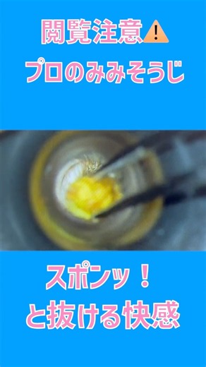 スポンッ！と抜ける快感：コロコロ耳垢を一発回収＃みみそうじ ＃耳垢