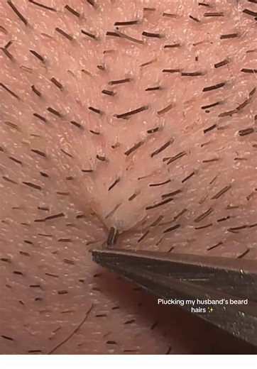 Happy Friday! 😅 plucking these thick hairs are definitely some of my favourites! My favourite was definitely the last one 🥵 #beardhairplucking #stranglysatifiying #extractions #ingrownhair #ingrown #asmrsounds #trichotillomania #compoundhair #thickhairpulls #fyppp