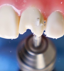 302K views · 533 reactions | Watch how dentists medically repair a chipped tooth! | 5-Minute Crafts Family | Facebook