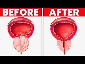 The EASY Way to Reduce Prostate Size Naturally in 2024!