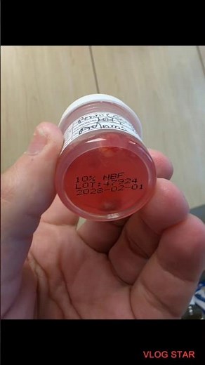 Had a small cyst, on my back, removed...