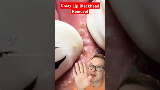 Crazy Wild LIP BLACKHEAD REMOVAL #shorts