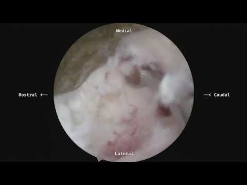 Upper Lumbar UBE Transforaminal Discectomy and osteophyte removal