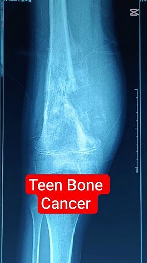 Ewing Sarcoma: The Silent Bone Cancer You Should Know #ortho #health #bone #surgeon #medical #zb